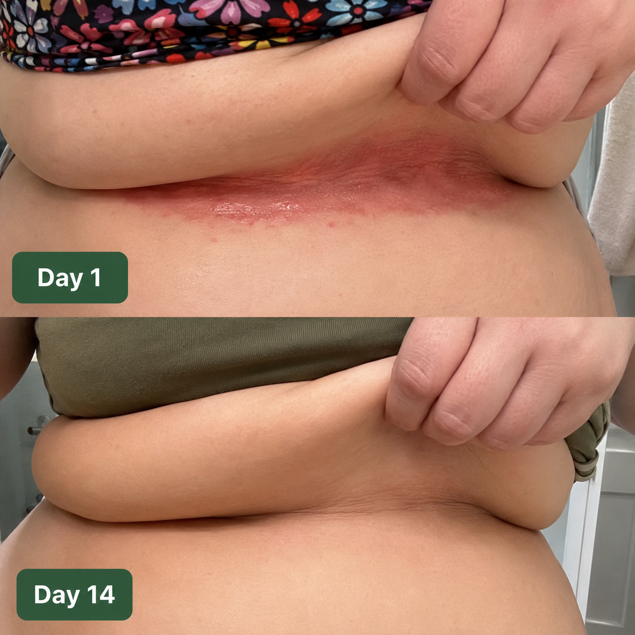 Ambero Antifungal Barrier Cream